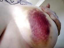 Extreme Bruising After Car Accident (2016)