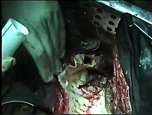 Russian Man Thoracic Aorta Replacement Surgery