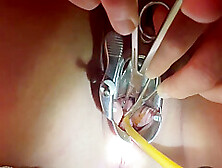 Tenaculum Grasping Cervix For Catheter 7 Min