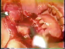 Young Argentinian Woman Tongue Base Tumor Resectio