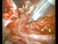 Thoracoscopic Thymectomy Woman