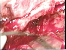 Cavernous Sinus Resection Extended Total Maxillect
