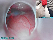 Japanese Uncensored Insemination Cum Into Uterus And Endoscope Camera By Cervix