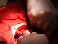 Russian Woman Open Coronary Artery Bypass Surgery
