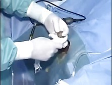 Transurethral Resection Of The Bladder Tumour Turbt For Non Musc