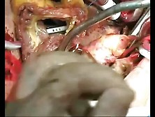 Artifical Heart Implantation