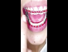 New Color Red Braces