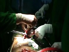 Open Thoracoabdominal Aortic Aneurysm Repair 7