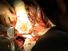 Open Thoracoabdominal Aortic Aneurysm Repair